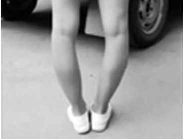 Как выглядят кривые ноги у девушек?